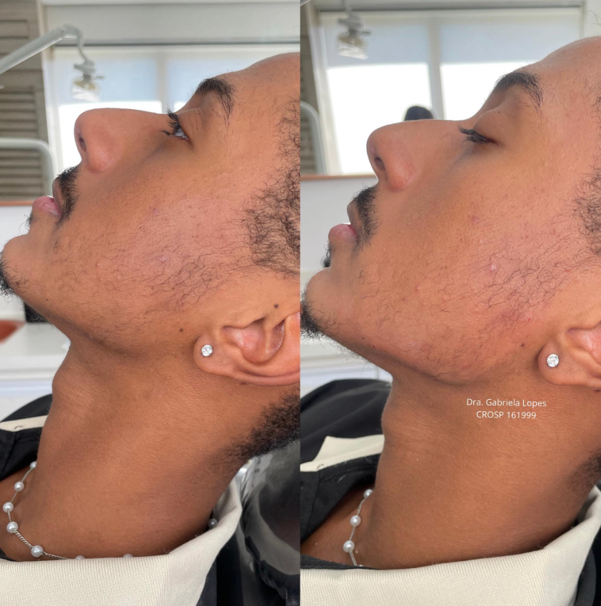 Harmonização Facial - antes e depois