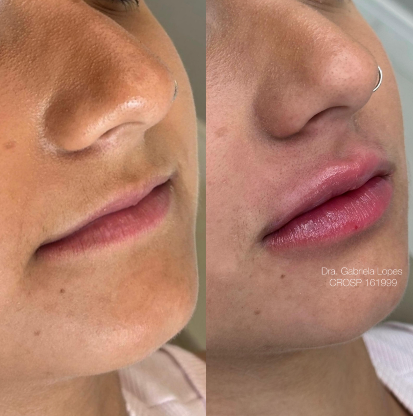 Preenchimento Labial - antes e depois