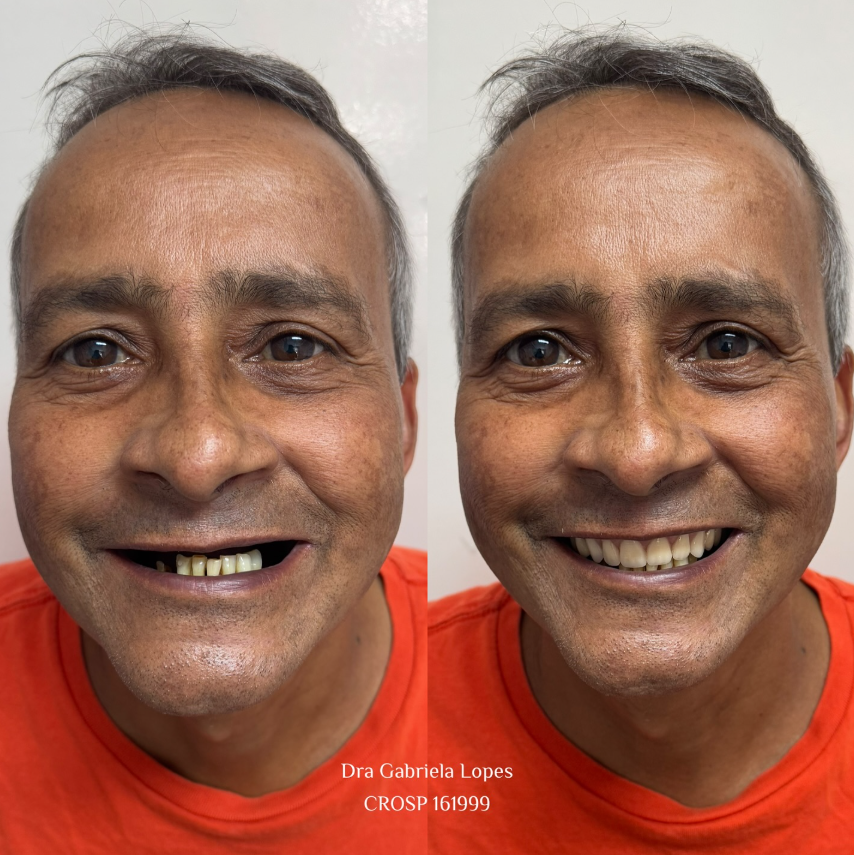 Prótese Total - antes e depois